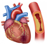 Is High Cholesterol Linked to Fatty Liver?